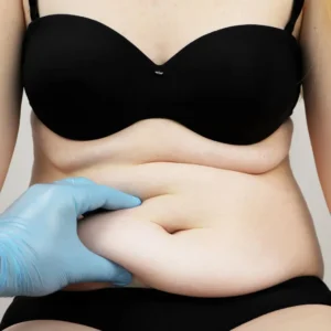 Dermolipectomia Não Estética: Entenda Seus Direitos pelo Plano de Saúde!