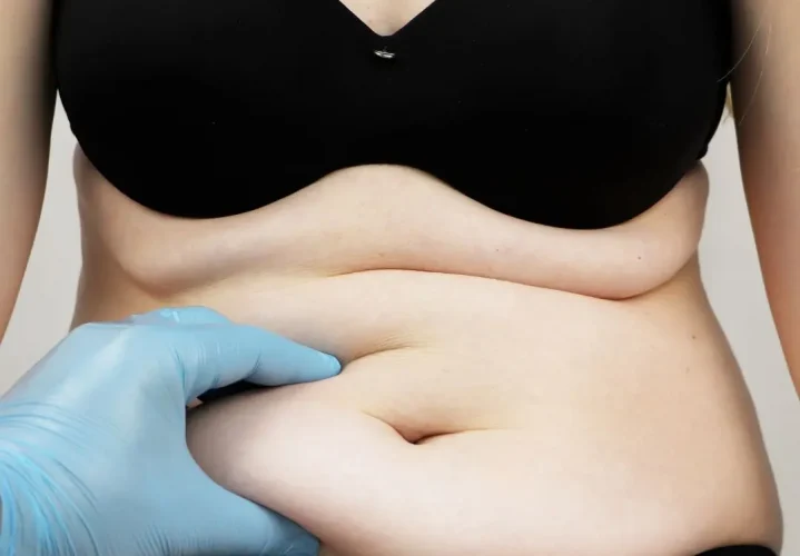 Dermolipectomia Não Estética: Entenda Seus Direitos pelo Plano de Saúde!